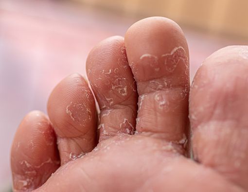 5 Cara Mudah Mencegah Kutu Air di Kaki