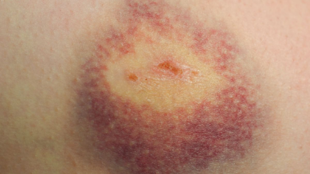 ITP (Purpura Trombositopenia Idiopatik)
