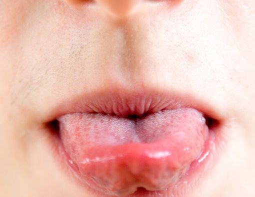 Penyebab Radang Permukaan Lidah yang Tak Boleh Anda Abaikan