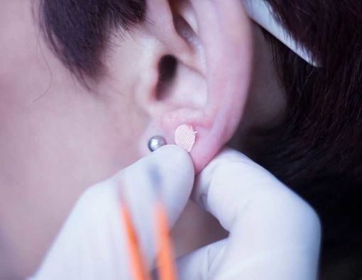 Manfaat Ear Seeds untuk Terapi Akupunktur pada Telinga