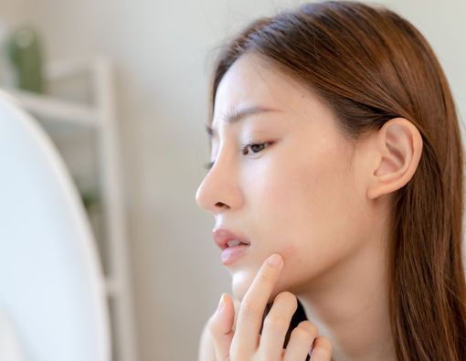 13 Cara Hilangkan Bekas Jerawat, Cepat dan Ampuh!