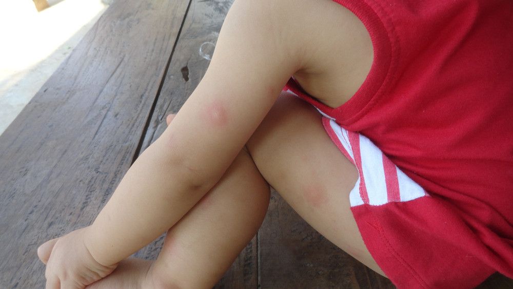 Mengapa Anak Sering Bisulan?