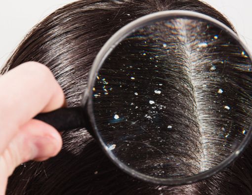  4 Jenis Ketombe yang Harus Kamu Tahu