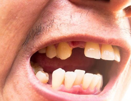 Osteoporosis dan Gigi Tanggal, Berhubungan?