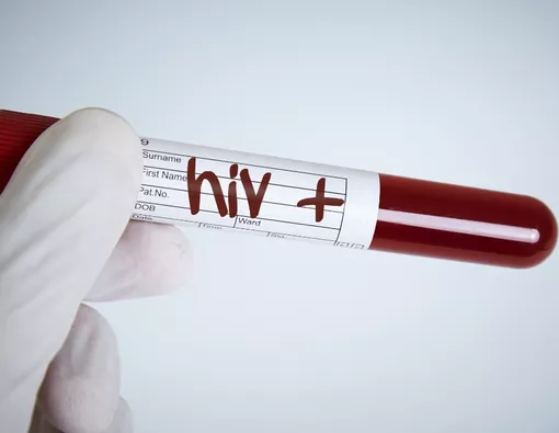 Hasil Tes HIV Reaktif (Positif), Ini 10 Hal yang Harus Kamu Lakukan
