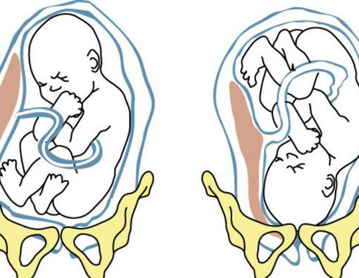 Kenali Penyebab Posisi Bayi Sungsang