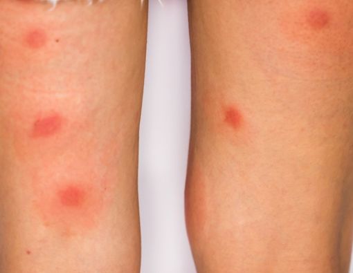 Waspada Bercak Merah Kecokelatan pada Kaki Pengidap Diabetes