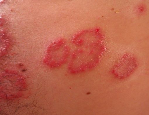 Mana Lebih Mudah Menular, Penyakit Kulit Virus, Bakteri, atau Jamur?