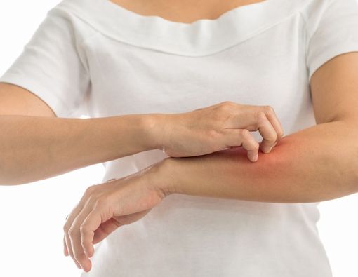 7 Pilihan Obat Paling Ampuh untuk Mengatasi Biduran