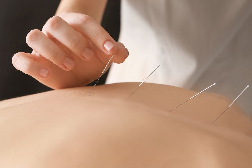 Akupunktur untuk Turunkan Berat Badan, Efektifkah?