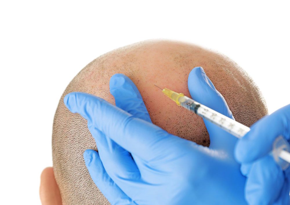 Awas, Obat untuk Rambut Rontok Bisa Picu Disfungsi Ereksi