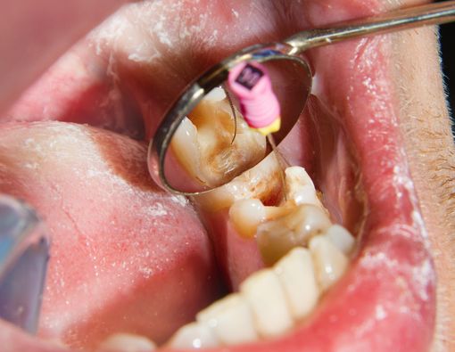 Benarkah Diabetes Bisa Bikin Gigi Keropos?