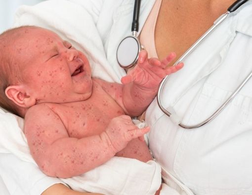 Kenali Hepatoblastoma, Kanker Hati yang Bisa Menyerang Bayi