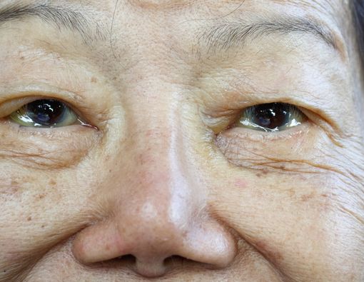 Mengapa Mata Lansia Sering Berair?