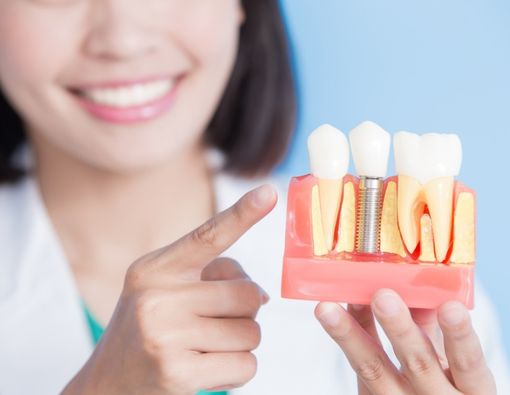 Cara Merawat Implan Gigi agar Tetap Sehat dan Kuat