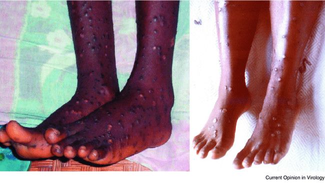 Mirip Impetigo Bulosa, Ini Bedanya dengan Cacar Monyet