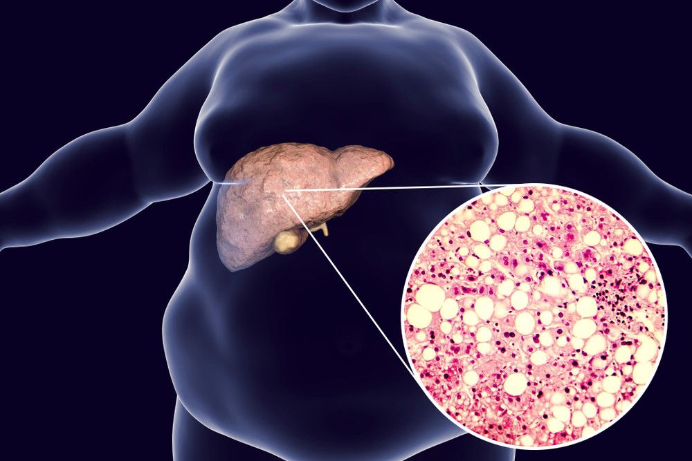 Waspadai 7 Faktor Risiko Fatty Liver Ini