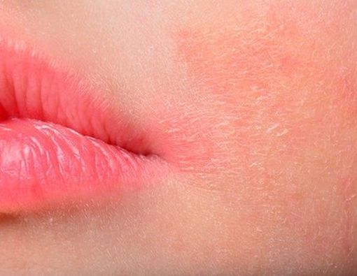 Virus Zika Dapat Ditularkan Melalui Hubungan Seksual, Benarkah?