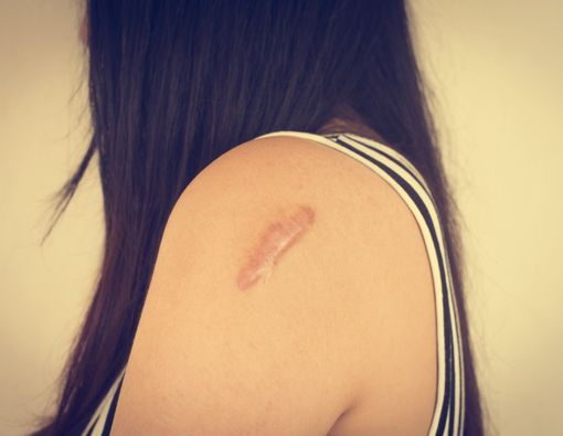 Keloid: Apa Itu, Penyebab, dan Ciri-Cirinya