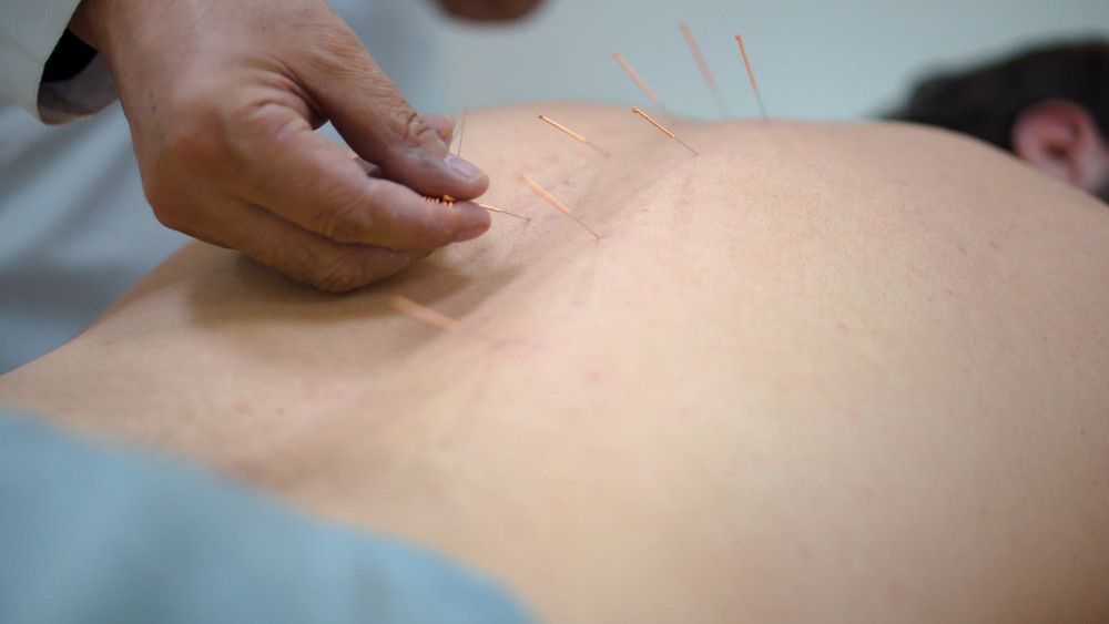 Benarkah Akupunktur Efektif untuk Atasi Obesitas?