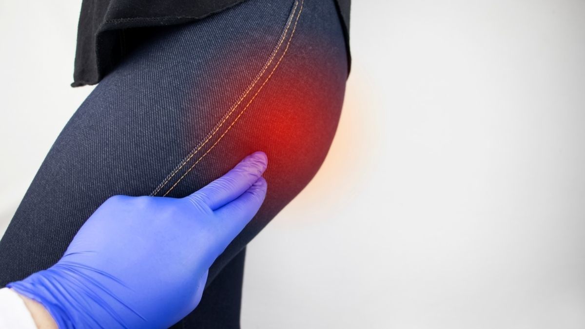 Pantat Kesemutan dan Mati Rasa, Awas Piriformis Syndrome!
