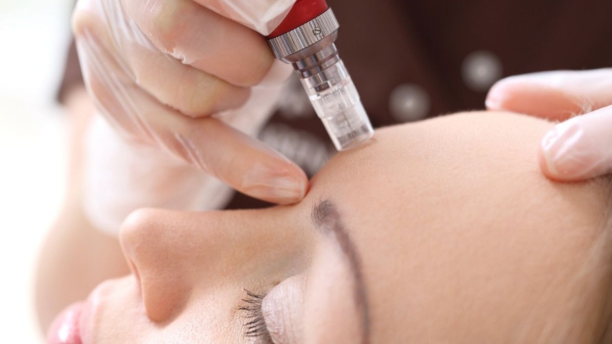 Waspada Bahaya Microneedling Makeup bagi Kulit Wajah