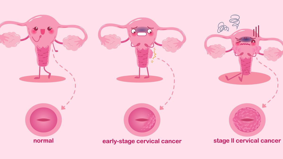 Cara Deteksi Dini dan Penanganan Kanker Serviks Stadium 1 - KlikDokter