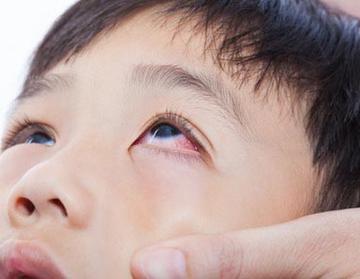 Berbagai Jenis Penyakit Mata yang Umum Terjadi