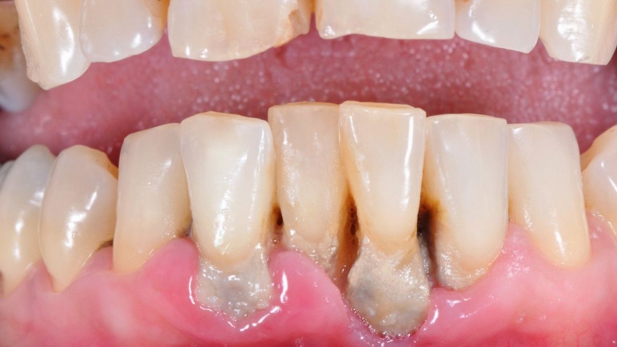 Jenis-Jenis Penyakit Periodontitis yang Harus Diketahui