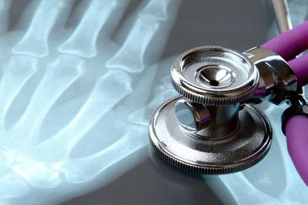 Perbedaan Utama Osteoporosis dan Osteopenia