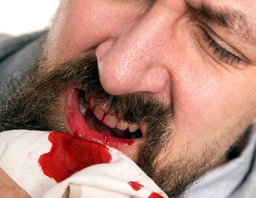 3 Penyakit Keturunan Penyebab Gusi Berdarah