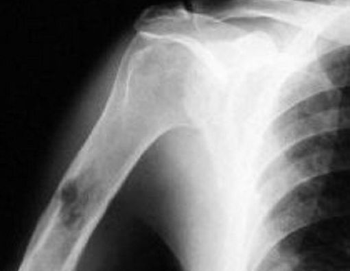 Kanker Tulang Mengintai Anak-anak &amp; Remaja