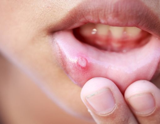 11 Cara Mengatasi Sariawan pada Anak Tanpa Rasa Sakit