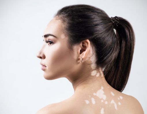 Vitiligo, Bisakah Sembuh?