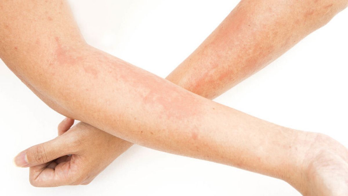 Ini Jenis-jenis Dermatitis Kontak dan Gejalanya