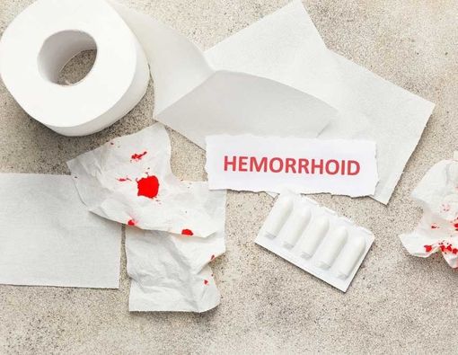 Penyebab dan Cara Mengatasi Ambeien Setelah Melahirkan