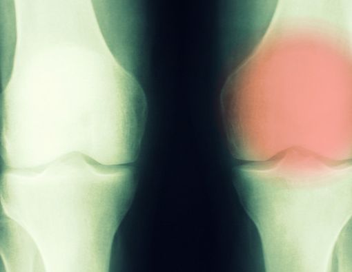 4 Gejala Kanker Tulang yang Tak Boleh Anda Sepelekan