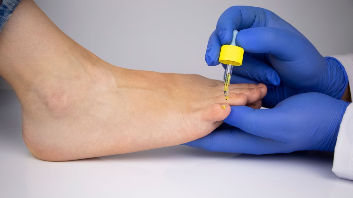 Pengobatan Kurap Secara Medis