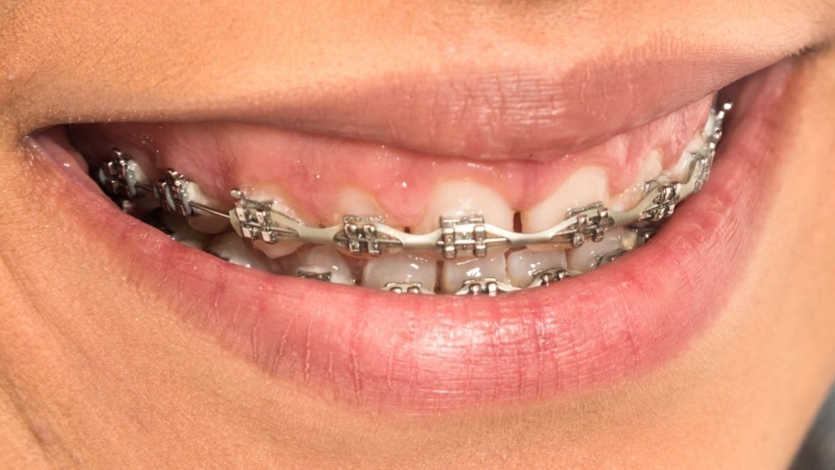 Manfaat dan Risiko Penggunaan Power Chain Braces