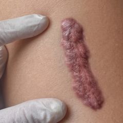 Cara Menghilangkan Keloid: Pilihan Perawatan yang Efektif