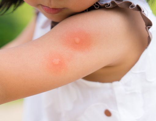 Jelang Musim Pancaroba, Awas Berbagai Penyakit Ini Mengintai Anak