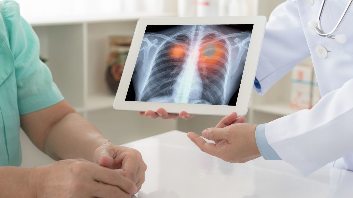 Mengenal Terapi RET Inhibitor untuk Kanker Paru