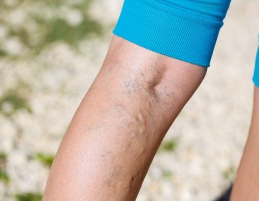 15 Cara Mencegah Varises