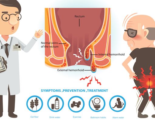 Apakah Wasir Merupakan Gejala Kanker Usus?