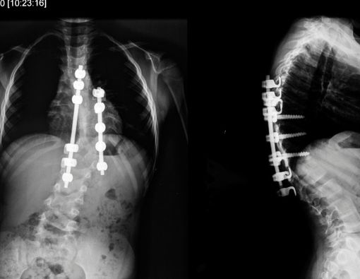 Benarkah Terapi Pijat Bisa Mengatasi Skoliosis?
