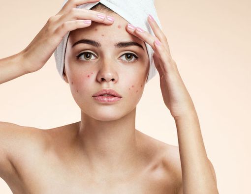 Wanita Haid Rentan Jerawatan