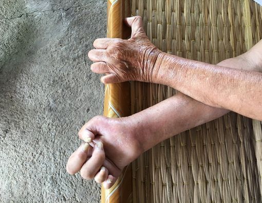 Mengapa Kusta Bisa Bikin Anggota Badan Copot?