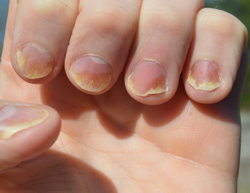 Kenali 5 Tanda Psoriasis dari Kuku Anda
