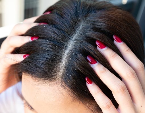 13 Rekomendasi Sampo Anti Ketombe Terbaik