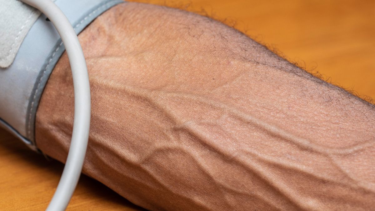 Penyebab Urat Menonjol dan Tampak di Kulit